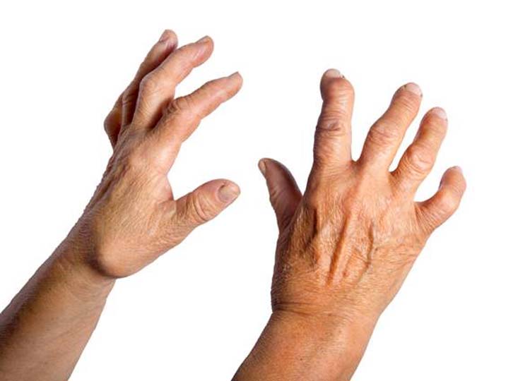 RHEUMATOID-ARTHRITIS